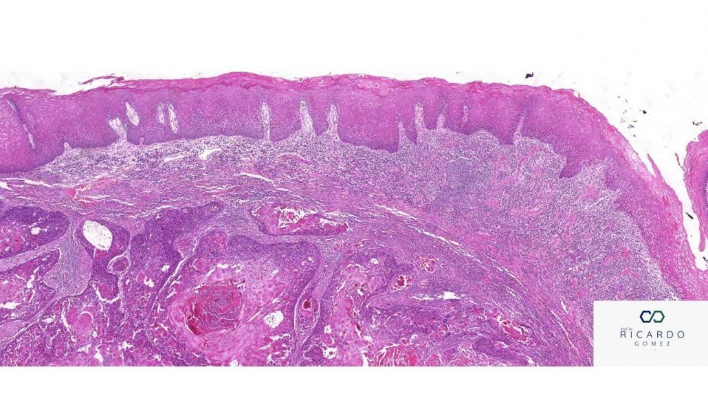 Imagem microscópica do carcinoma de células escamosas de boca