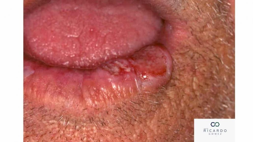 Imagem de carcinoma de células escamosas no lábio