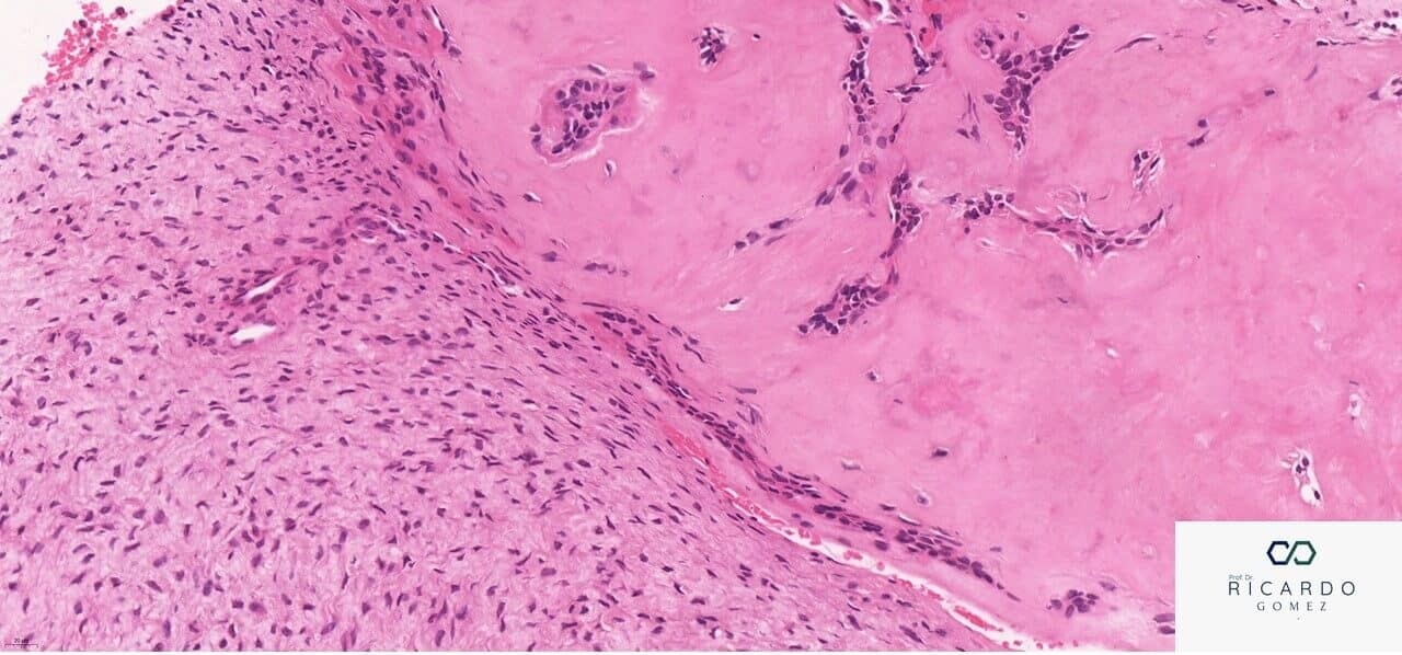Imagem microscópica do fibrodentinoma ameloblástico.