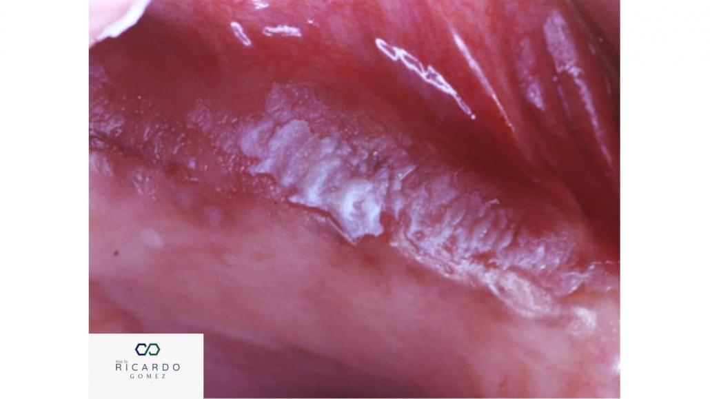 Aspecto clínico da leucoplasia oral