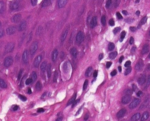 Imagem microscópica de um melanócito na mucosa oral