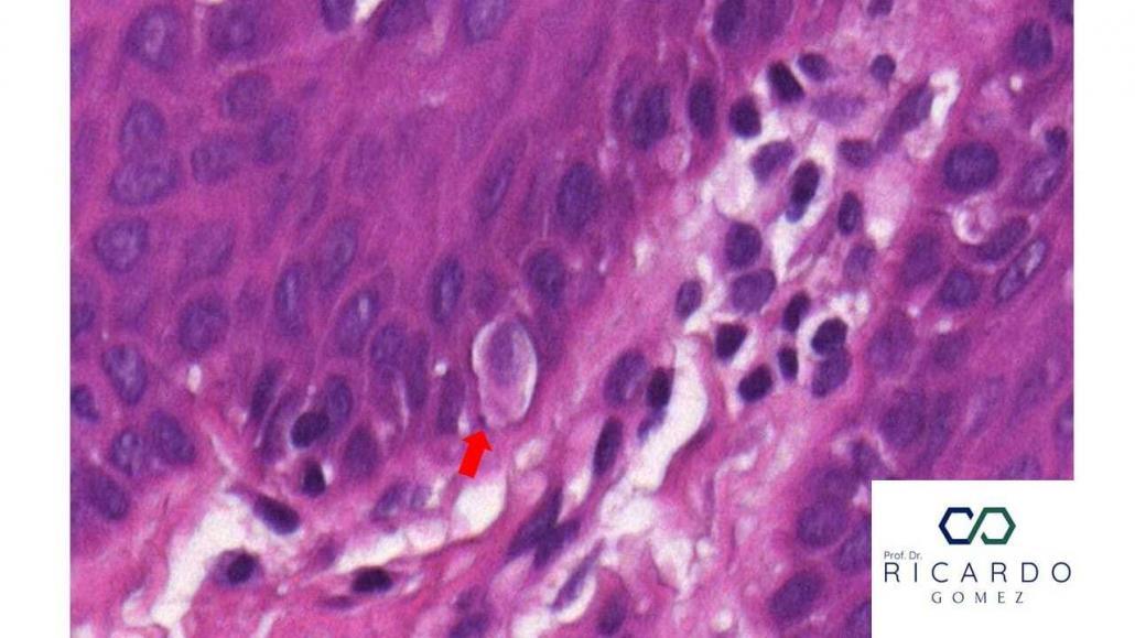 Imagem microscópica de um melanócito na mucosa oral