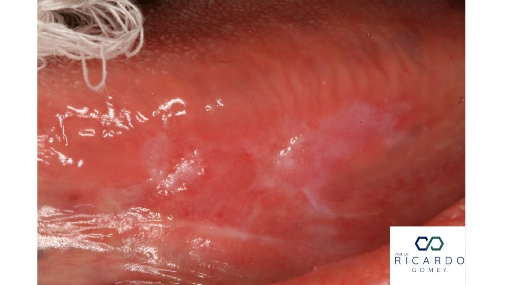 Imagem clínica do carcinoma de células escamosas de boca.