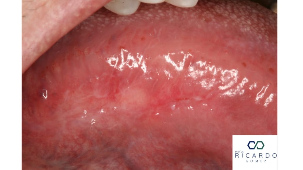 Imagem clínica do carcinoma de células escamosas de boca.