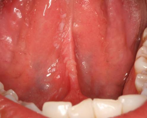 Imagem clínica de candidíase oral